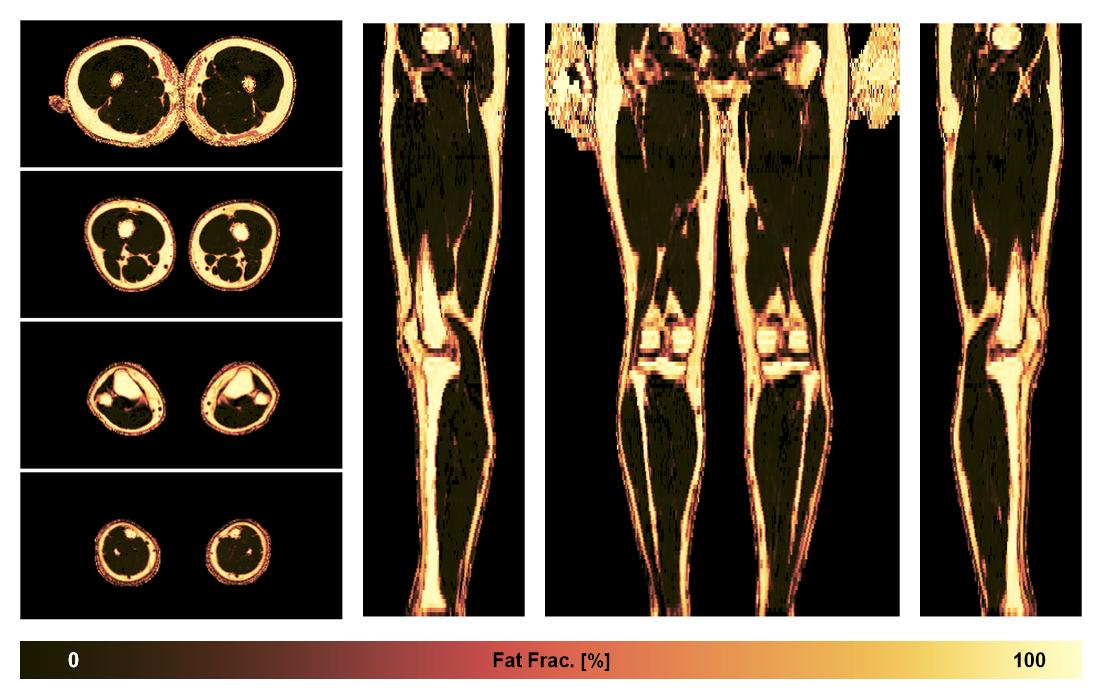 The fat fraction of the lower extremity obtained from the dixon reconstruction for muscle water fat quantification.